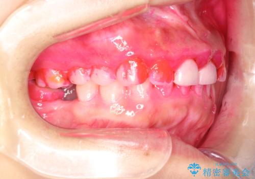 矯正治療を考えている方のクリーニングの治療前