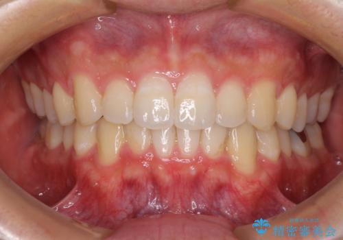 口が少し閉じにくい インビザラインによる非抜歯矯正の治療後