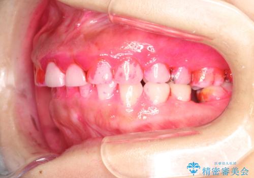 矯正治療を考えている方のクリーニングの治療前