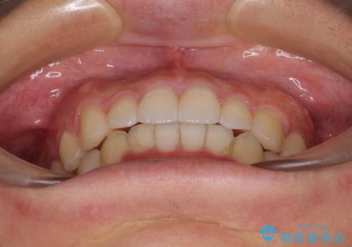 口が少し閉じにくい　インビザラインによる非抜歯矯正の治療後