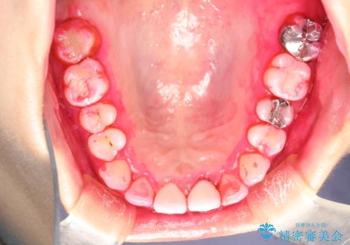 矯正治療を考えている方のクリーニングの治療中