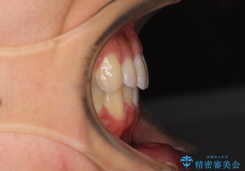 口が少し閉じにくい　インビザラインによる非抜歯矯正の治療後