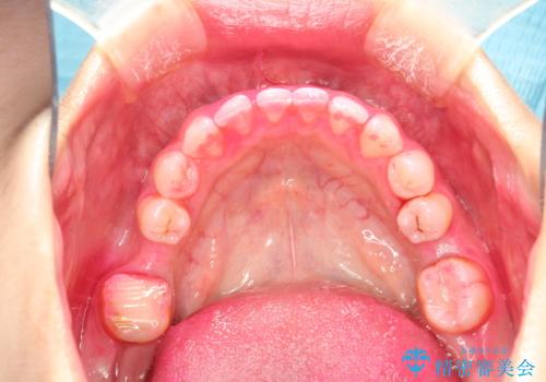 矯正治療を考えている方のクリーニングの治療前