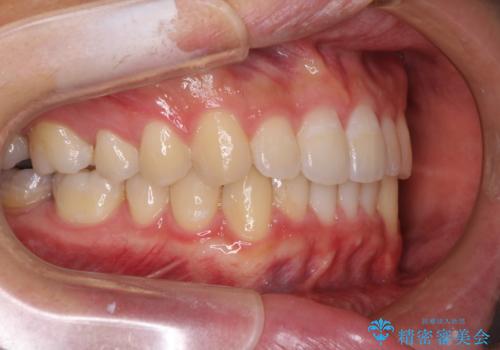 口が少し閉じにくい インビザラインによる非抜歯矯正の治療後