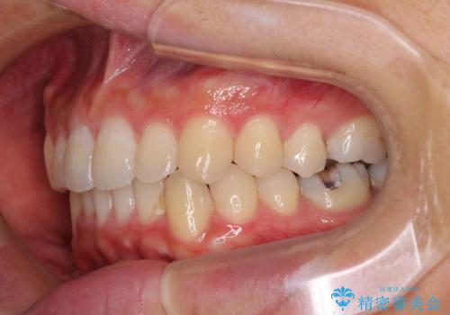 口が少し閉じにくい インビザラインによる非抜歯矯正の治療後