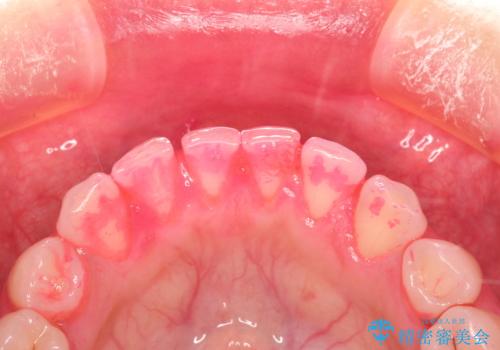 矯正治療を考えている方のクリーニングの治療前
