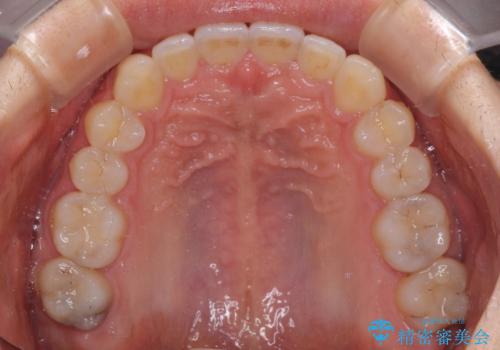 口が少し閉じにくい インビザラインによる非抜歯矯正の治療後