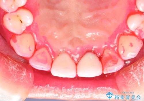 矯正治療を考えている方のクリーニングの治療中