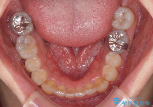 口が少し閉じにくい インビザラインによる非抜歯矯正の治療後