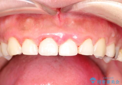 矯正治療を考えている方のクリーニングの治療後