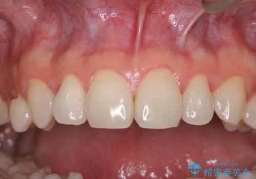 40年ぶりの歯科医院へ来院の治療後