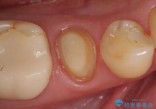オールセラミッククラウン 神経が死んでいる歯の治療の治療中