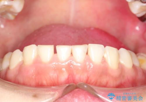 矯正治療を考えている方のクリーニングの治療後
