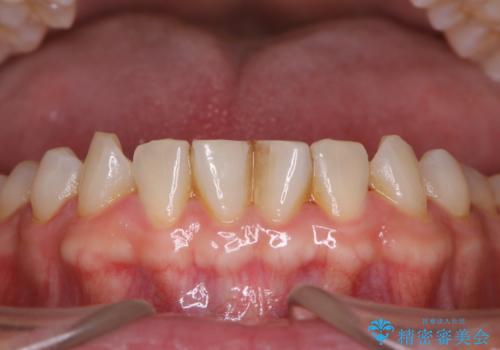 40年ぶりの歯科医院へ来院の治療前