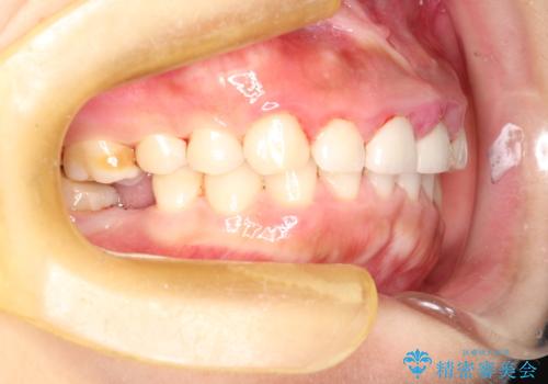 矯正治療を考えている方のクリーニングの治療後