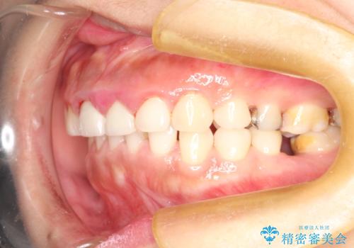 矯正治療を考えている方のクリーニングの治療後