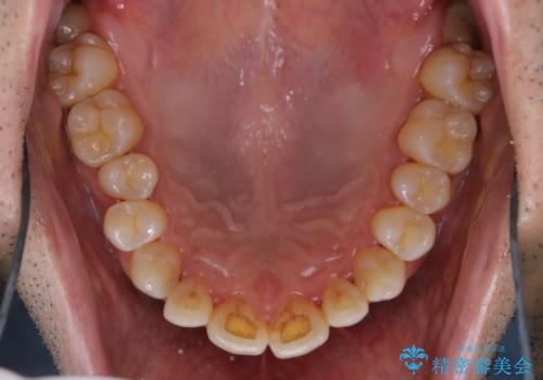 40年ぶりの歯科医院へ来院の治療前