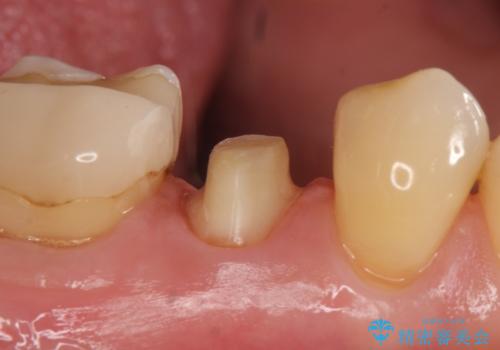 オールセラミッククラウン 神経が死んでいる歯の治療の治療中