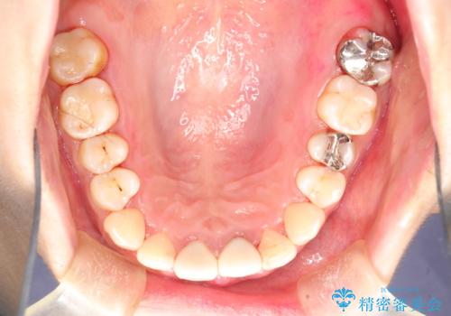 矯正治療を考えている方のクリーニングの治療後