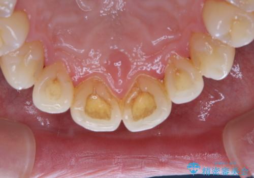 40年ぶりの歯科医院へ来院の治療前