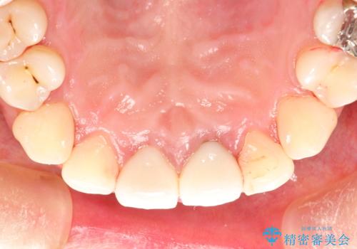 矯正治療を考えている方のクリーニングの治療後