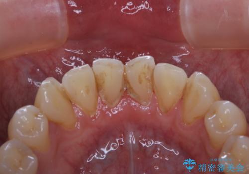 40年ぶりの歯科医院へ来院の治療前