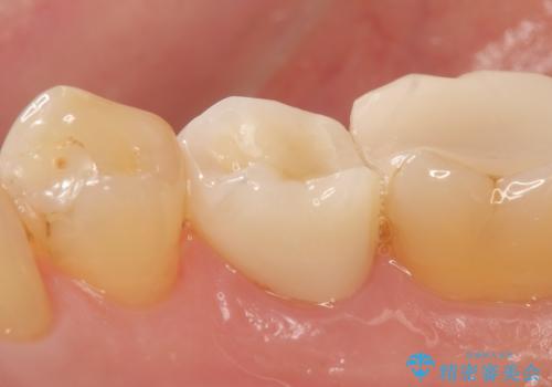 オールセラミッククラウン 神経が死んでいる歯の治療の治療後