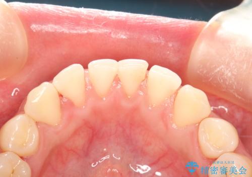 矯正治療を考えている方のクリーニングの治療後