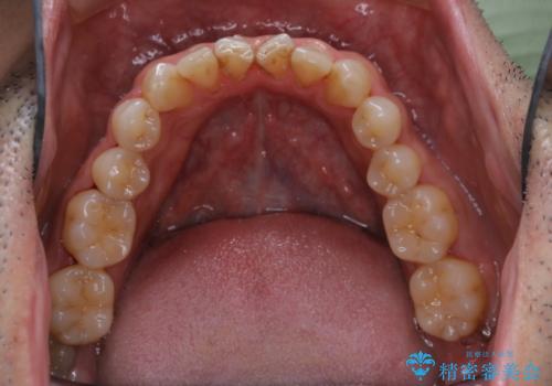 40年ぶりの歯科医院へ来院の治療前