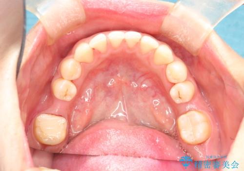 矯正治療を考えている方のクリーニングの治療後