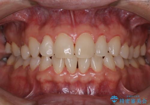 40年ぶりの歯科医院へ来院の症例 治療後