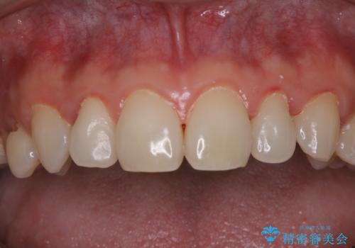 40年ぶりの歯科医院へ来院の治療前