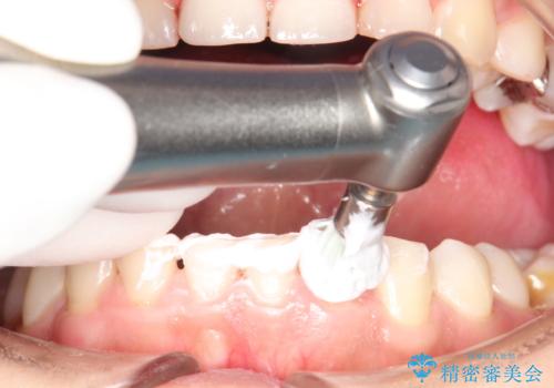 矯正治療を考えている方のクリーニングの治療中