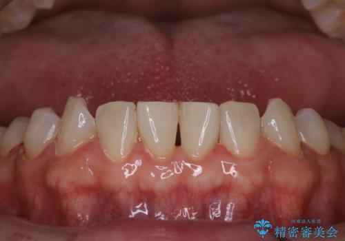 40年ぶりの歯科医院へ来院の治療後