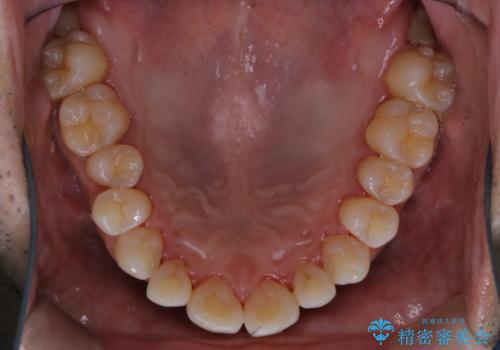 40年ぶりの歯科医院へ来院の治療後