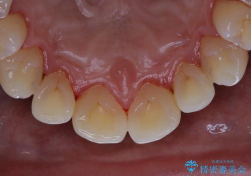 40年ぶりの歯科医院へ来院の治療後