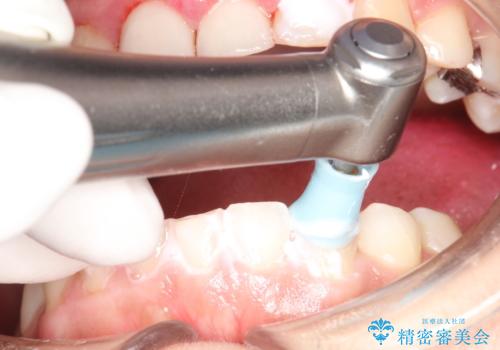 矯正治療を考えている方のクリーニングの治療中