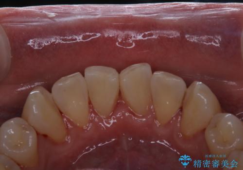 40年ぶりの歯科医院へ来院の治療後