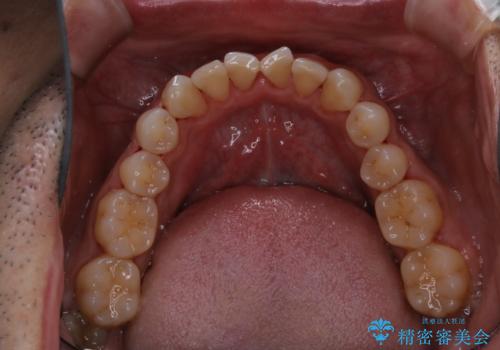 40年ぶりの歯科医院へ来院の治療後