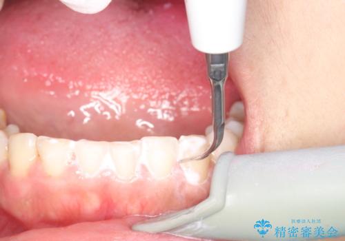 矯正治療を考えている方のクリーニングの治療中