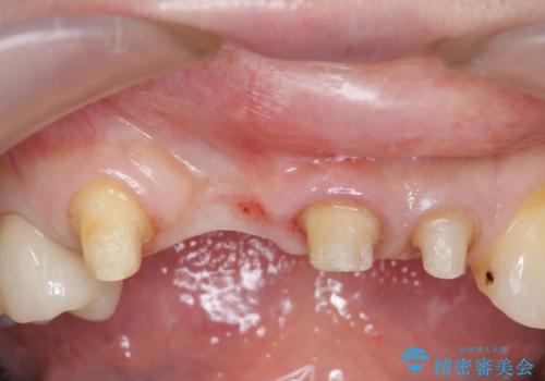 前歯のブリッジ　オールセラミッククラウン　歯根が割れてしまった歯の治療の治療中