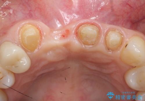 前歯のブリッジ オールセラミッククラウン 歯根が割れてしまった歯の治療の治療中