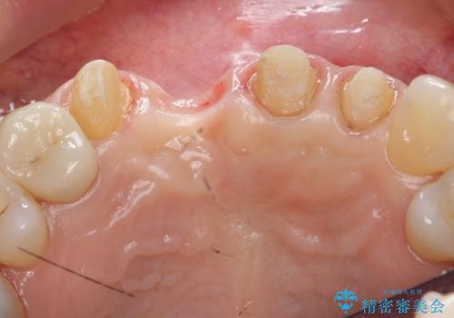 前歯のブリッジ　オールセラミッククラウン　歯根が割れてしまった歯の治療の治療中