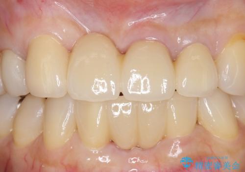 前歯のブリッジ オールセラミッククラウン 歯根が割れてしまった歯の治療の治療後