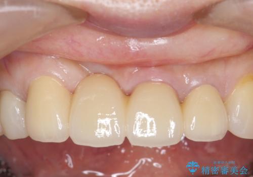 前歯のブリッジ　オールセラミッククラウン　歯根が割れてしまった歯の治療の症例 治療後