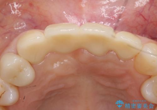 前歯のブリッジ　オールセラミッククラウン　歯根が割れてしまった歯の治療の治療後