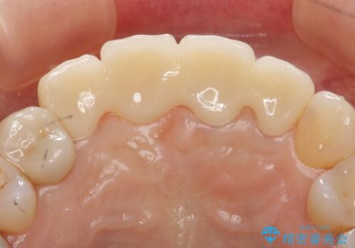 前歯のブリッジ オールセラミッククラウン 歯根が割れてしまった歯の治療の治療後