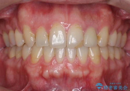 出っ歯　すれ違い咬合の改善　の治療後