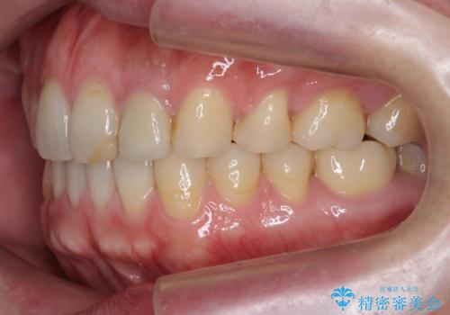 出っ歯　すれ違い咬合の改善　の治療後