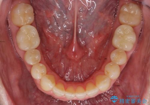 出っ歯　すれ違い咬合の改善　の治療後